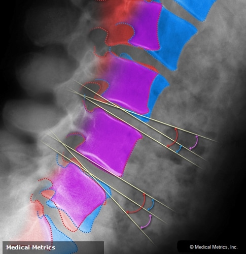 QMA® is MMI’s proprietary radiographic measurement and image enhancement technology that has been extensively validated and used in numerous clinical and research studies of treatments for spinal disorders.