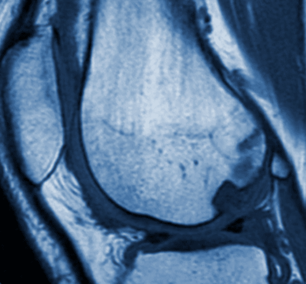 Knee-Cartilage-Repair