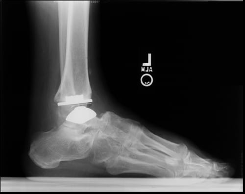 Medical Metrics imaging services helped facilitate the approval of the STAR ankle implant.