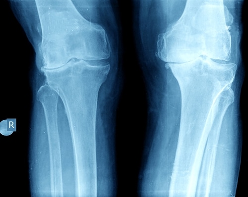 An artificial meniscus has long eluded researchers.