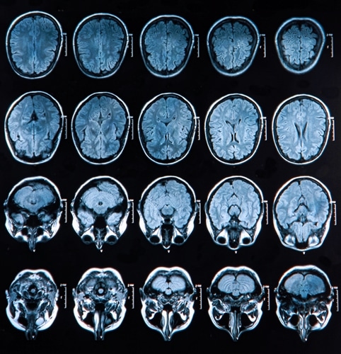 Small lesions can increase patients' risk of stroke mortality.