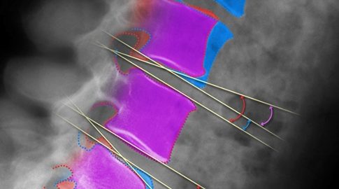 QMA® is MMI’s proprietary radiographic measurement and image enhancement technology that has been extensively validated and used in numerous clinical and research studies of treatments for spinal disorders.