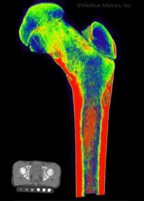 Femoral bone density analysis from CT