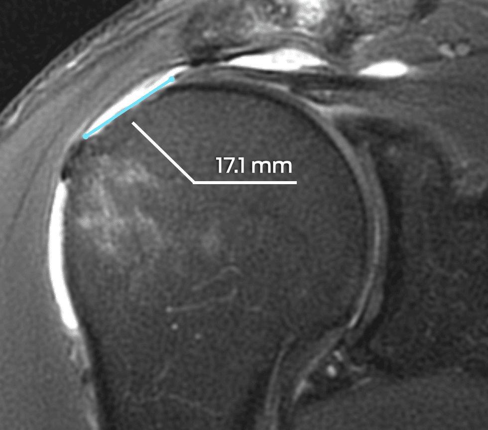 Preoperative rotator cuff tear length on sagittal MR