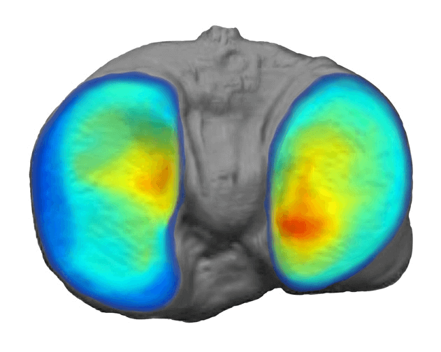 Tibial-Cartilage-Thickness-Map