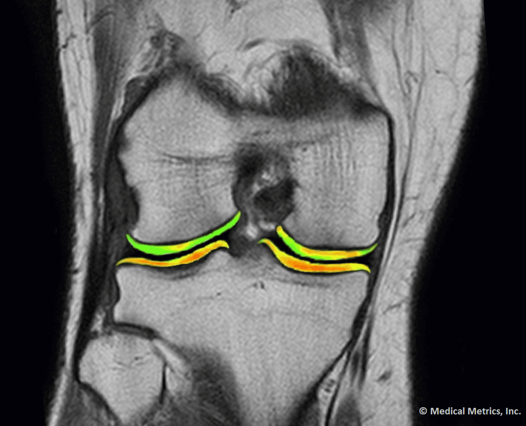 cartilage-map