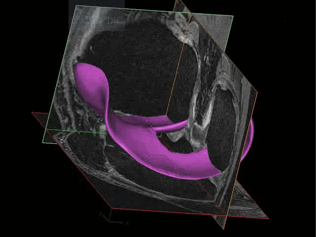 3D surface of cartilage created from an MRI