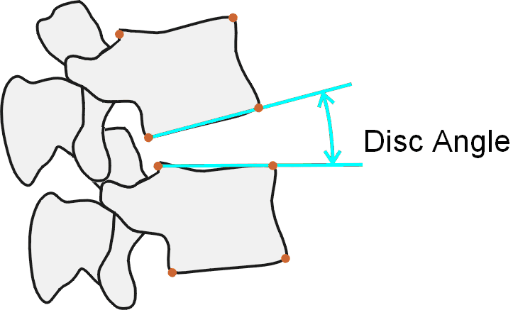 lumbardiscangle