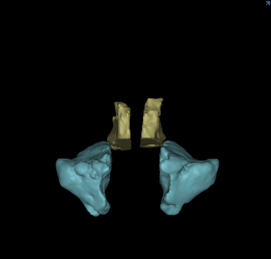 3D reconstruction of total ethmoid (yellow) and maxillary (blue) sinus volumes