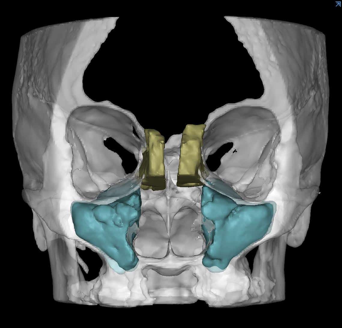 3D reconstruction of total ethmoid (yellow) and maxillary (blue) sinus volumes overlaid on top of partial skull reconstruction