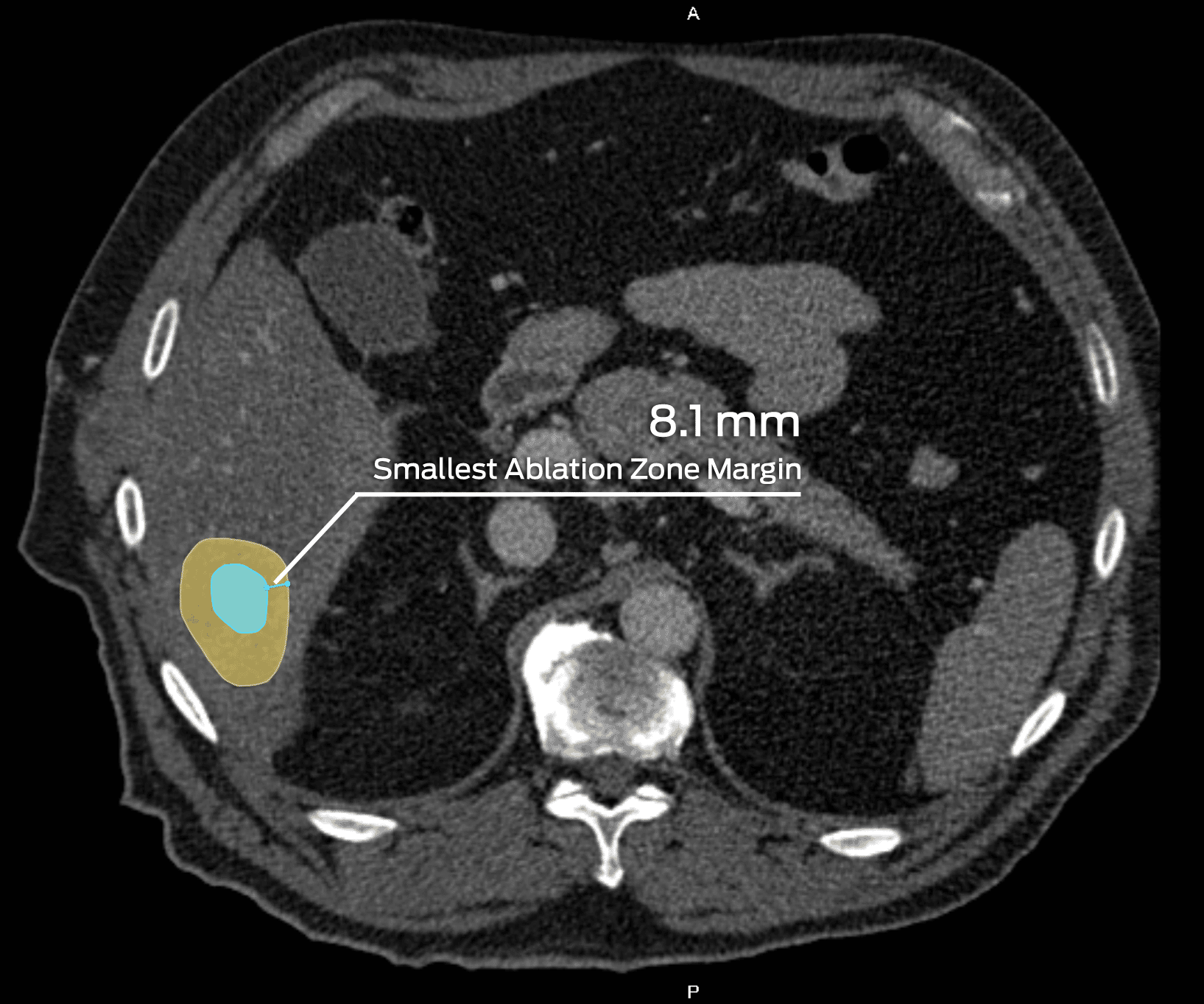 Liver lesion ablation zone margin post-treatment on axial CT