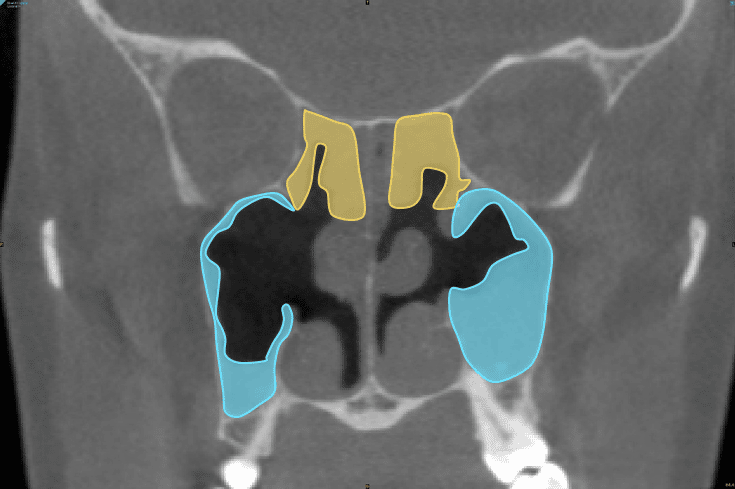 Quantification of ethmoid (yellow) and maxillary (blue) sinus opacification in coronal CT