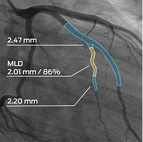 Post-treatment revascularization of the coronary artery