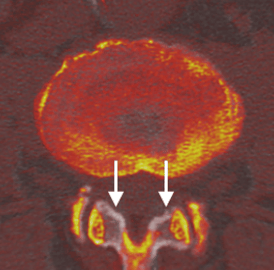 PostOp (color) CT image overlaid on the PreOp (grayscale) image, showing regions of bone that were removed during decompression (white arrows).