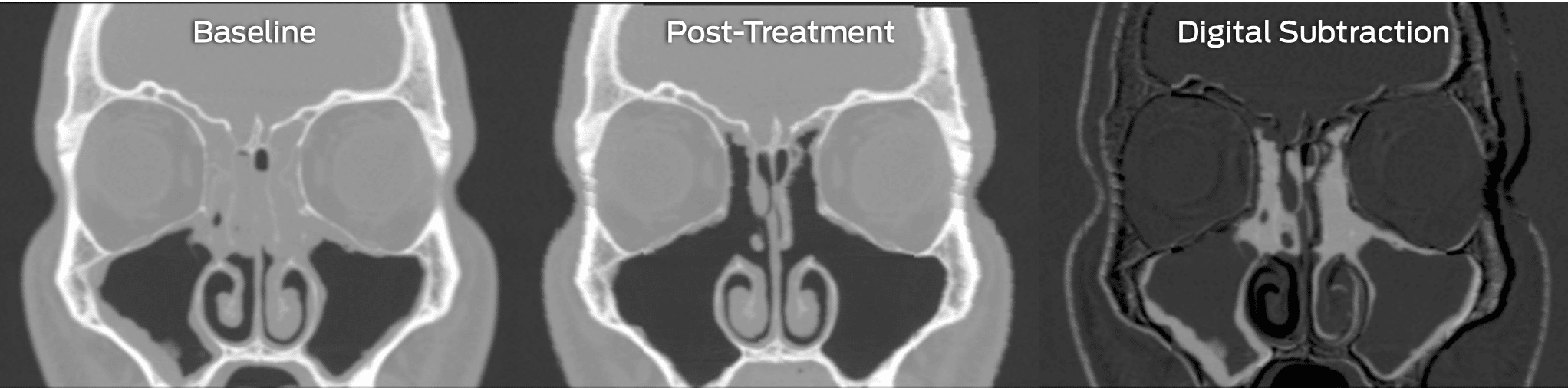 Digital subtraction technique for determining the difference between baseline and post-treatment images to identify areas of reduced sinus opacification