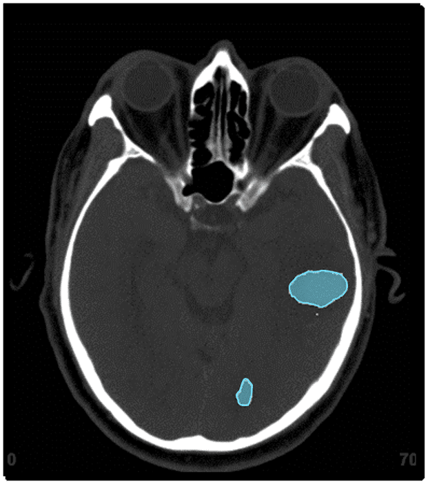 Identification of infarct locations