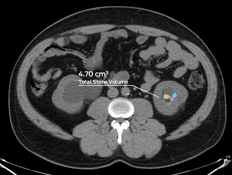 Assessment of total kidney stone volume preoperatively using CT