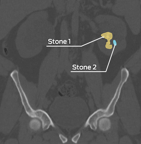 Identification and volumetric analysis of renal calculi: coronal CT