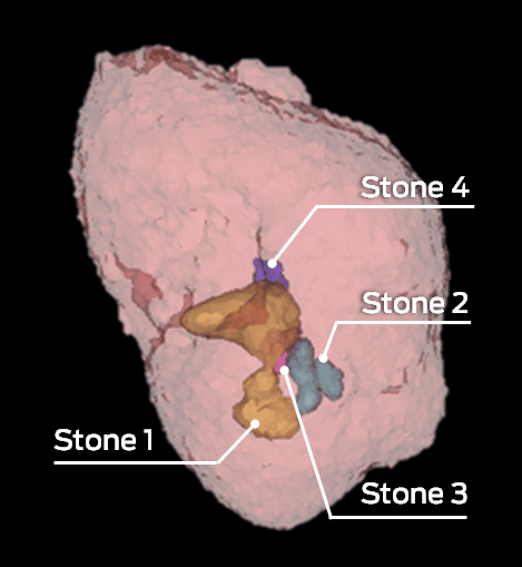 Identification and volumetric analysis of renal calculi: 3D rendering