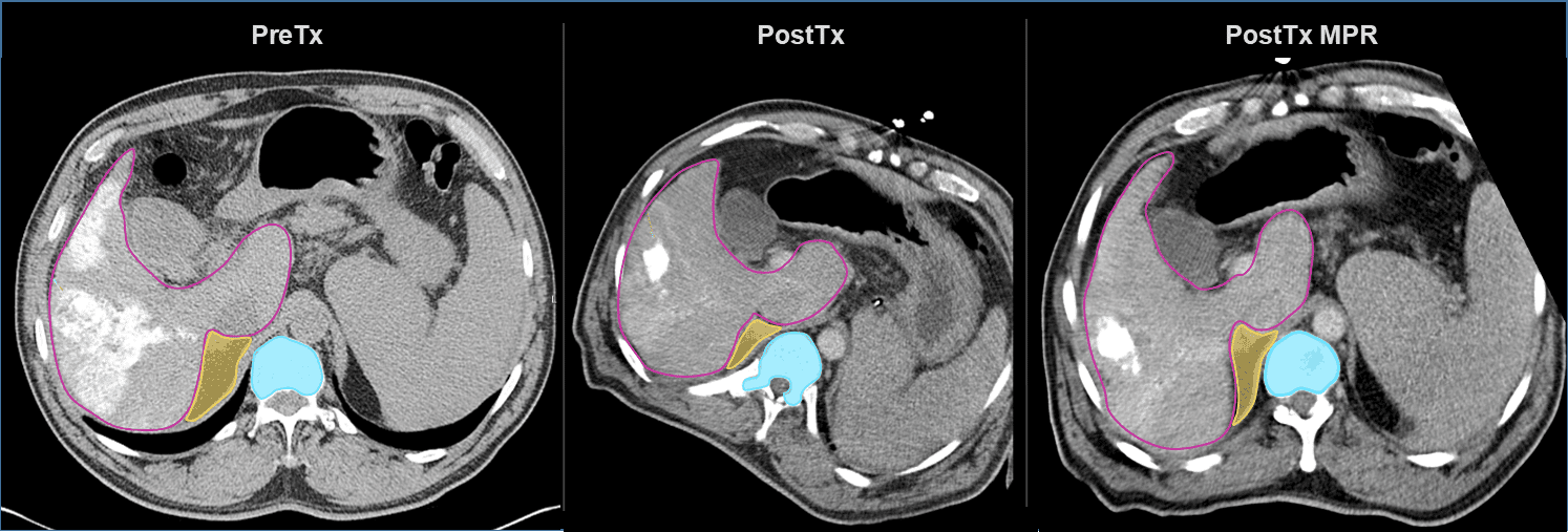 Multi-planar reconstruction (MPR) of the post-treatment CT to match the pre-treatment orientation for improved comparisons across visits