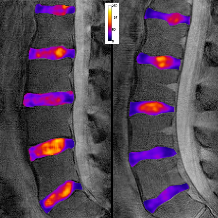 MR relaxation mapping to quantify disc quality during repair and regeneration