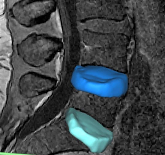 Segmented disc volume overlaid on MR image slice