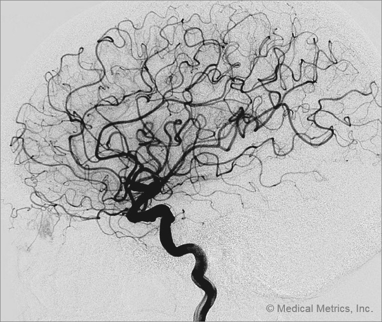 Neuroangiography