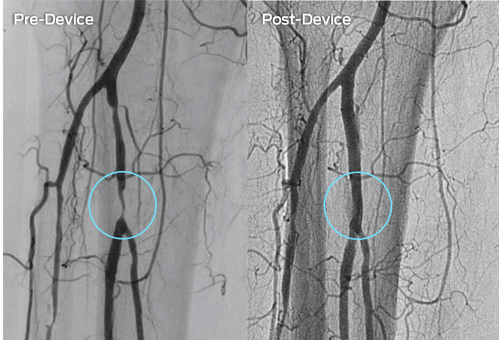 Pad-revascularization