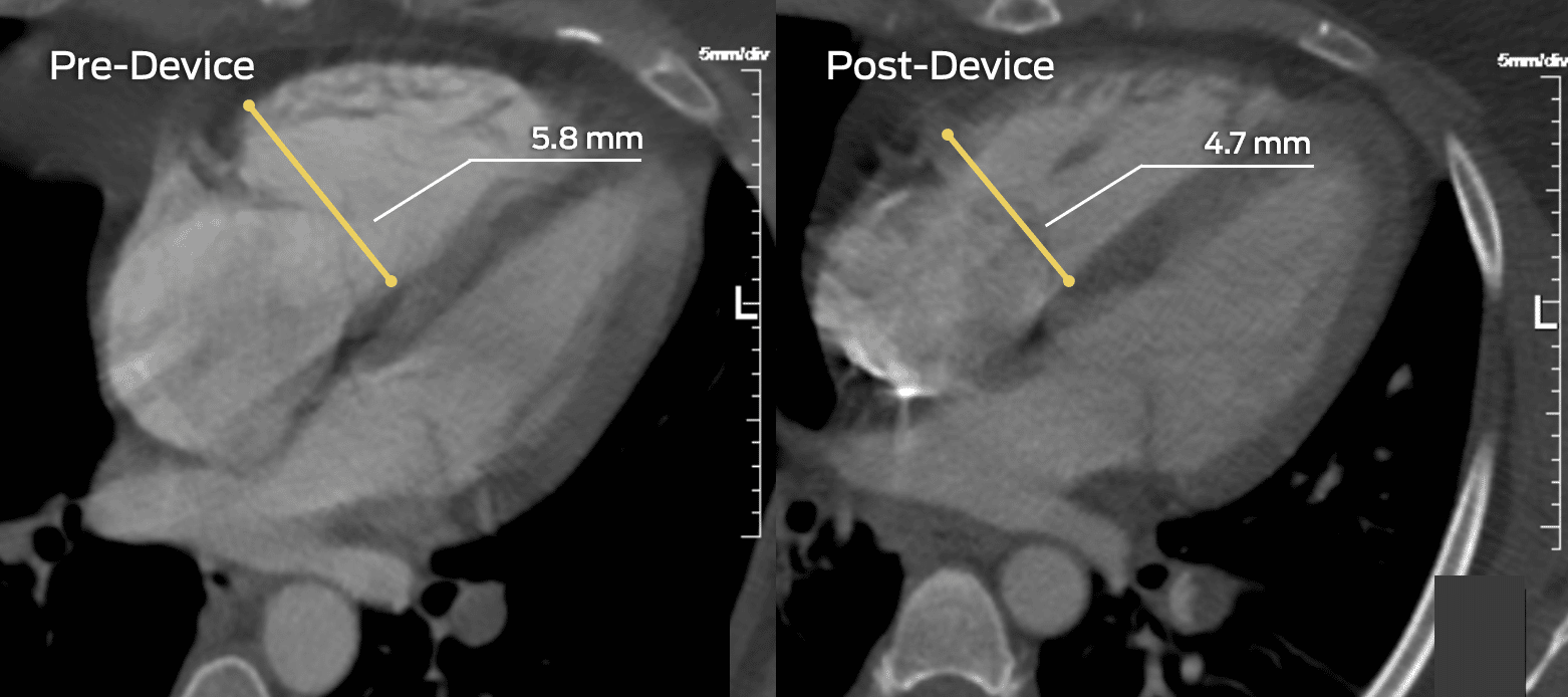 Pre and post-removal of submissive pulmonary embolism: reconstructed 4-chamber view measuring ventricular diameter