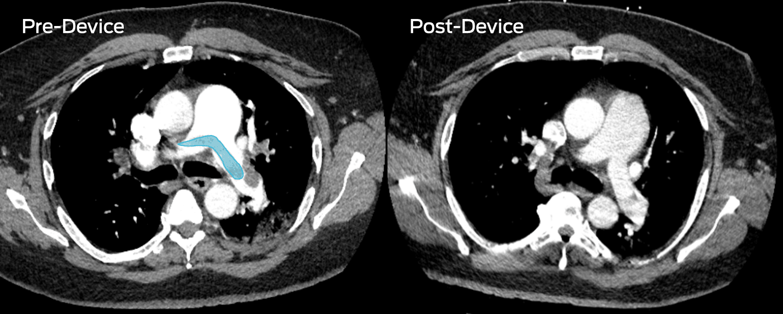 Chest CTA taken pre- and post-removal of submissive pulmonary embolism