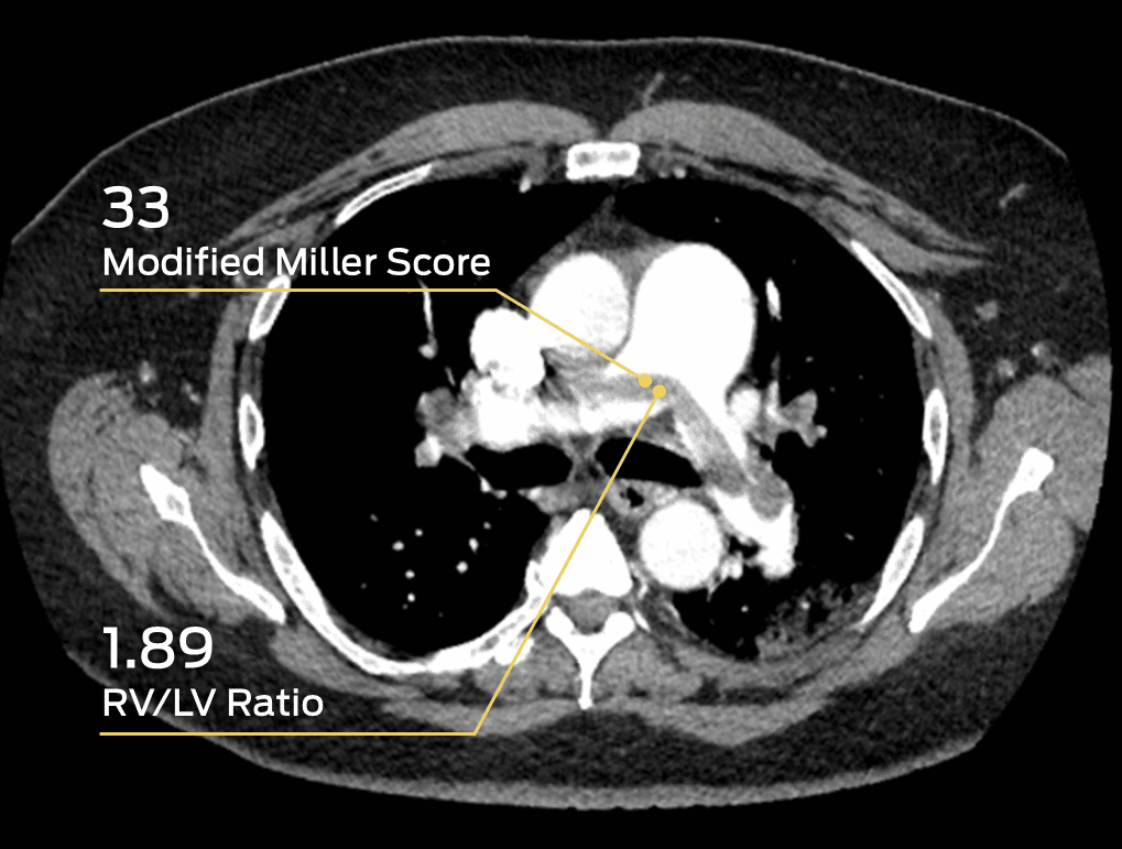 Assessment of pulmonary embolism preoperatively on axial CTA