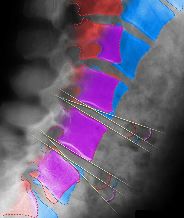 High-precision measurements of disc angle in flexion and extension using MMI’s proprietary QMA® analysis technology