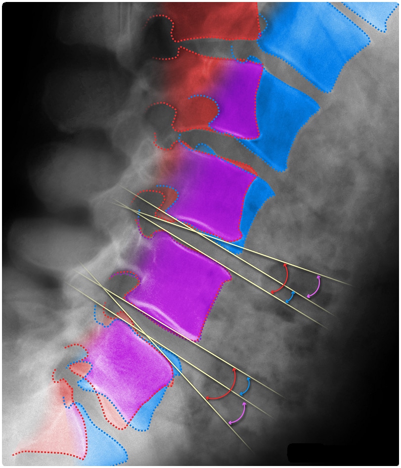 High-precision measurements of disc angle in flexion and extension using MMI’s proprietary QMA® analysis technology