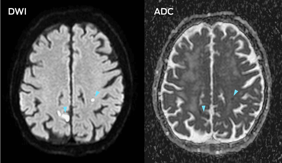 DWI and ADC map capturing micro-infarcts in the brain following a TAVR procedure