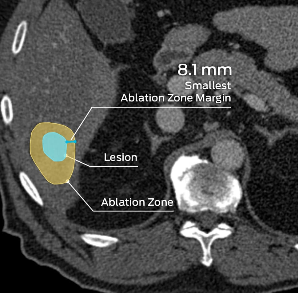 Thoracoabdominal