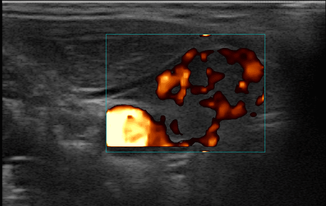 Ultrasound imaging of thyroid tumor