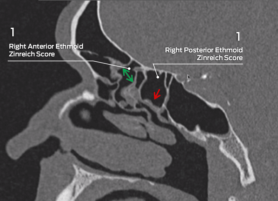 Zinreich scores of right anterior and posterior ethmoid sinuses on sagittal CT