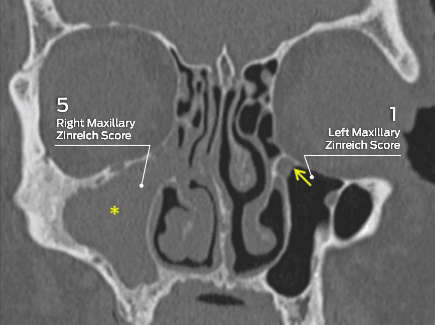 Zinreich scores of left and right maxillary sinuses on coronal CT