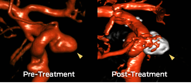 3D angiography illustrating pre- and post- treatment of a wide-neck aneurysm with coiling and stenting