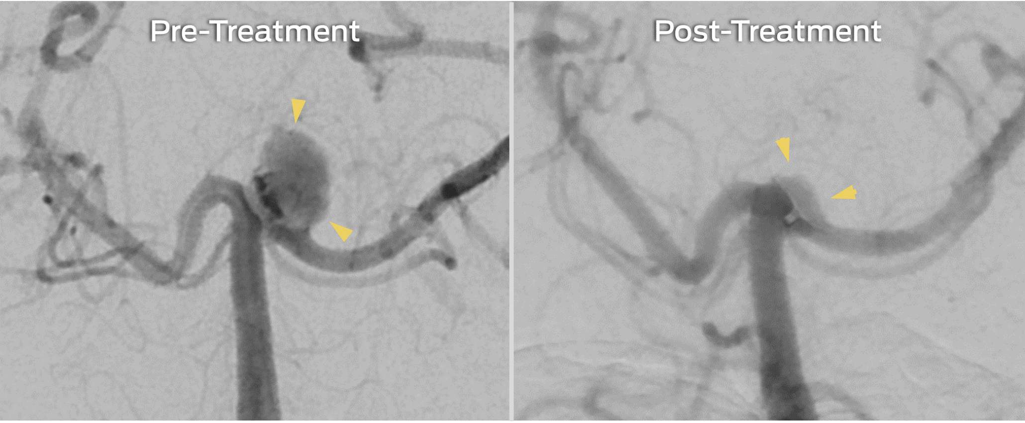 DSA images showing pre- and post-treatment of an aneurysm with a flow diverter